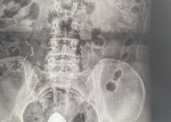 MULHER SOFRE ACIDENTE COM OBJETO ÍNTIMO E PRECISA DE ATENDIMENTO MÉDICO URGENTE