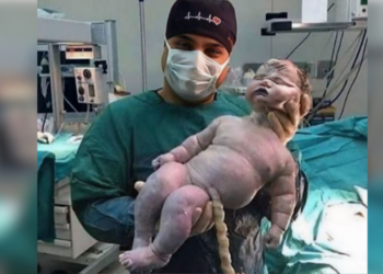 Bebê nasce com 7,9 kg em parto vaginal e surpreende equipe médica