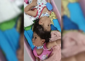 Gêmeas siamesas unidas pela cabeça morrem em cirurgia de separação