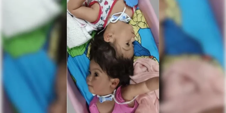 Gêmeas siamesas unidas pela cabeça morrem em cirurgia de separação