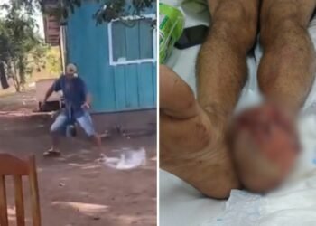 Tentativa de apagar explosivo com o pé termina em tragédia e homem sofre amputação dos dedos