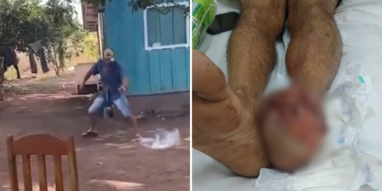 Tentativa de apagar explosivo com o pé termina em tragédia e homem sofre amputação dos dedos