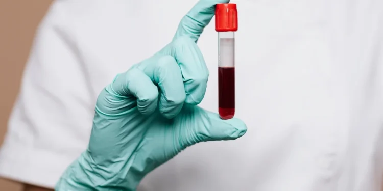 Estudo investiga se há risco de transmissão do Alzheimer pelo sangue