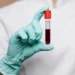 Estudo investiga se há risco de transmissão do Alzheimer pelo sangue