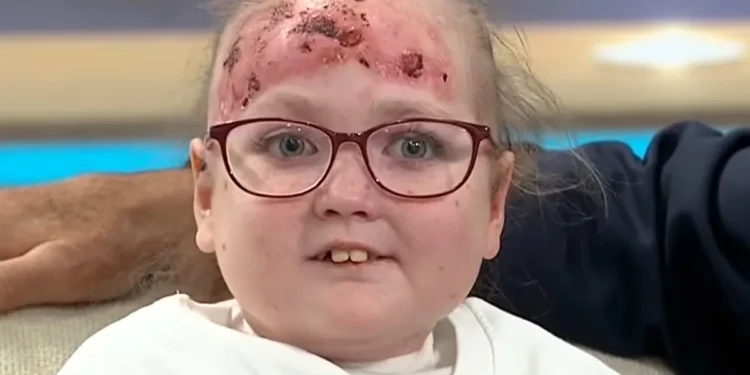 Doença rara deixa menina de 14 anos com bolhas e dor por todo o corpo