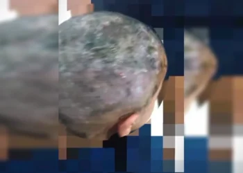 Larvas na cabeça: pais são presos por suspeita de maus-tratos e negligência