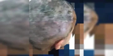 Larvas na cabeça: pais são presos por suspeita de maus-tratos e negligência